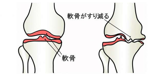 膝の骨の画像　ここが軟骨　ここは軟骨がすり減っている